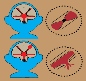 뇌출혈과 뇌경색