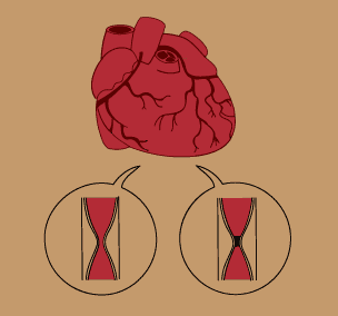 angina pectoris and myocardial infarction