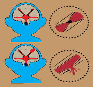 cerebral hemorrhages and cerebral infarctions